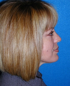 Rhinoplasty