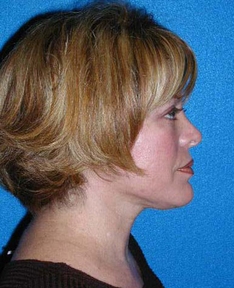 Rhinoplasty