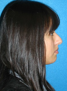 Rhinoplasty