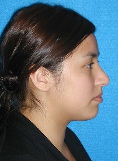 Rhinoplasty