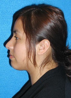 Rhinoplasty