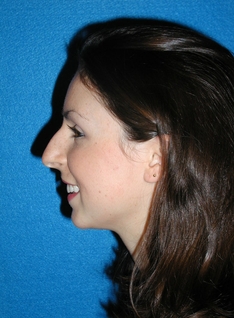 Rhinoplasty