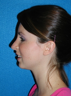 Rhinoplasty