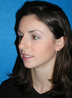 Rhinoplasty