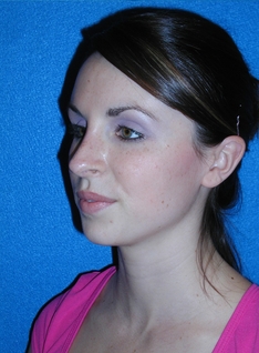 Rhinoplasty