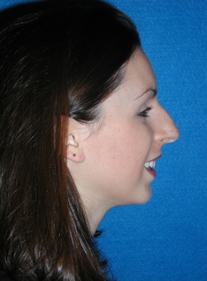 Rhinoplasty