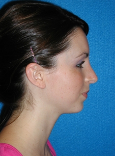 Rhinoplasty