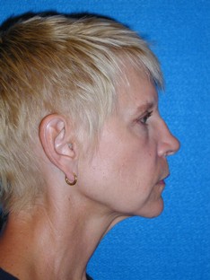 Rhinoplasty