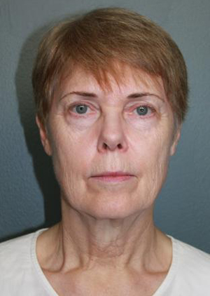 Facelift/Necklift