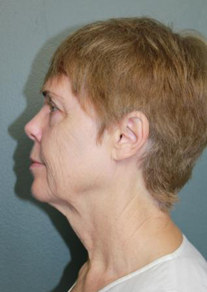 Facelift/Necklift