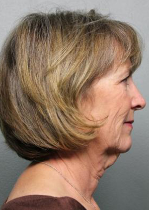 Facelift/Necklift