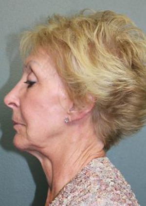 Facelift/Necklift