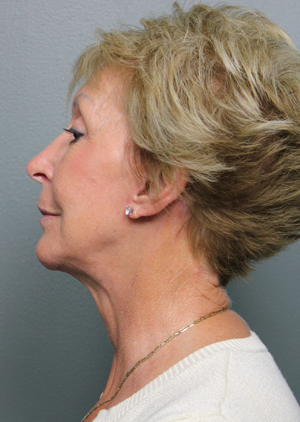 Facelift/Necklift