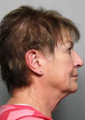 Facelift/Necklift