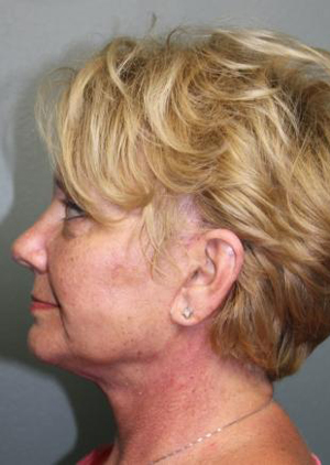 Facelift/Necklift