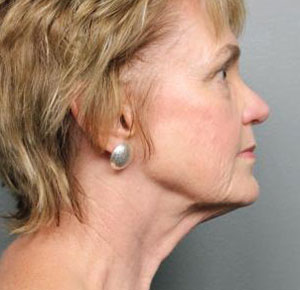 Facelift/Necklift