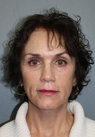 Facelift/Necklift