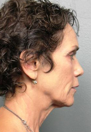 Facelift/Necklift