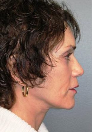 Facelift/Necklift