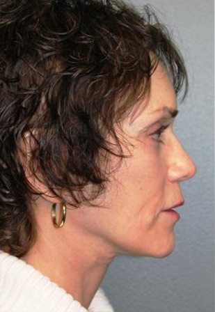 Facelift/Necklift