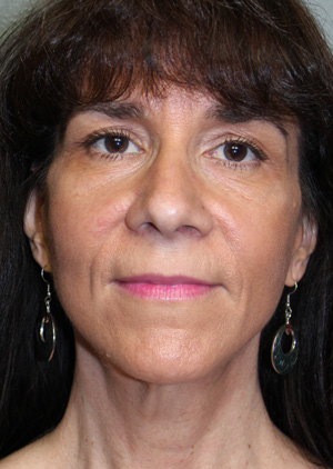 Facelift/Necklift