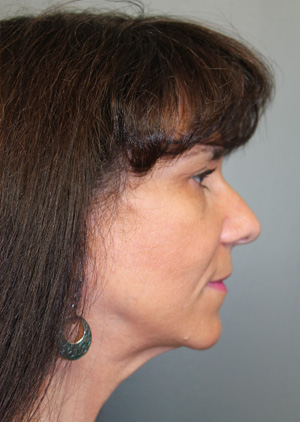 Facelift/Necklift