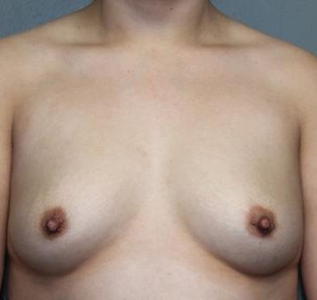 Breast Augmentation