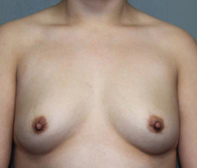 Breast Augmentation