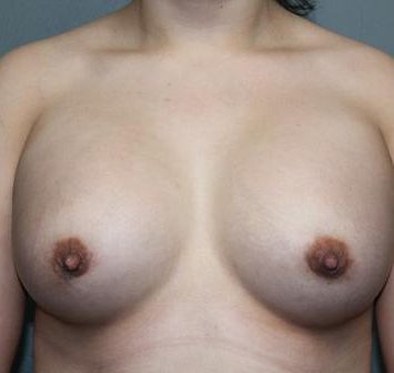 Breast Augmentation