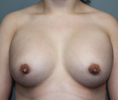 Breast Augmentation