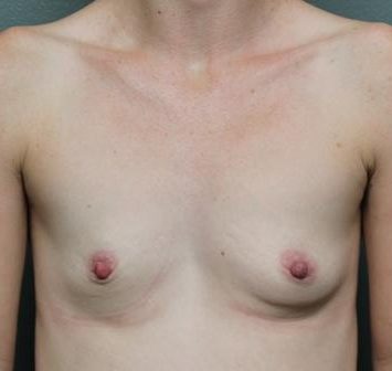 Breast Augmentation