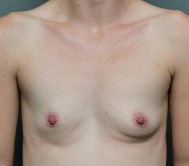 Breast Augmentation