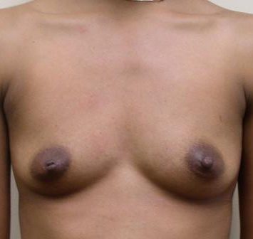 Breast Augmentation