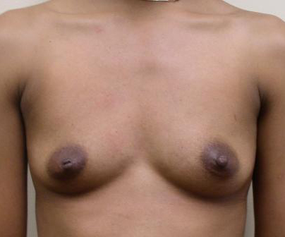 Breast Augmentation