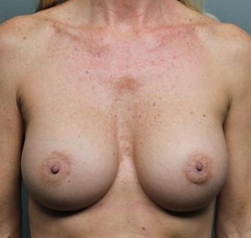 Breast Augmentation