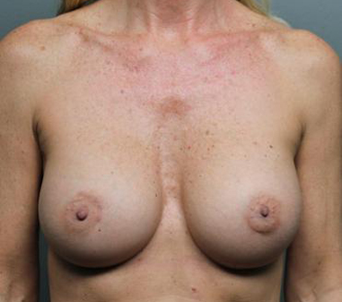 Breast Augmentation