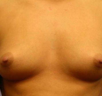 Breast Augmentation