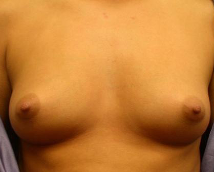 Breast Augmentation