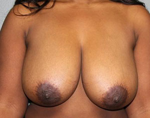 Breast Reduction