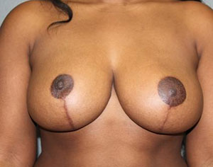 Breast Reduction