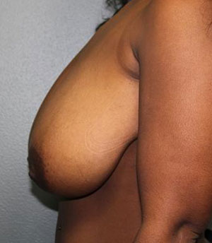 Breast Reduction