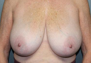 Breast Reduction