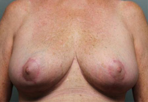 Breast Reduction