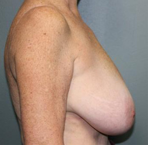 Breast Reduction