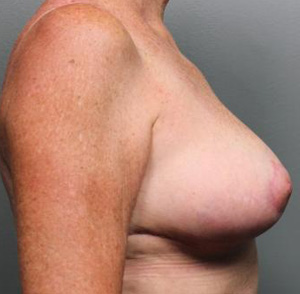 Breast Reduction