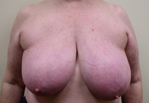 Breast Reduction