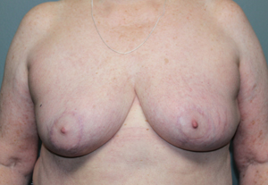 Breast Reduction