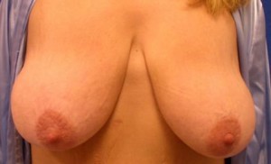 Breast Lift