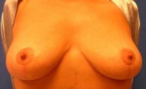 Breast Lift