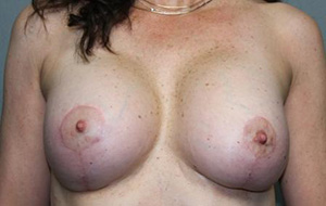 Breast Lift